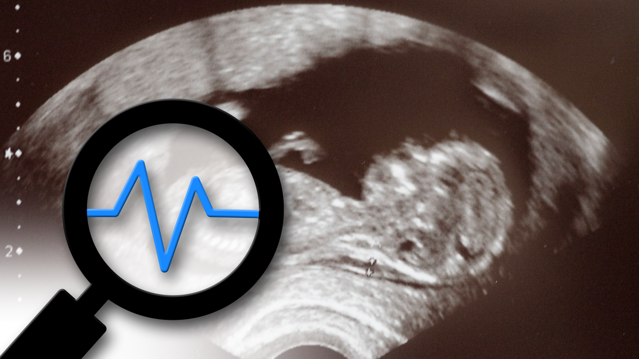 Ultraschallbild bei der Pränataldiagnostik 