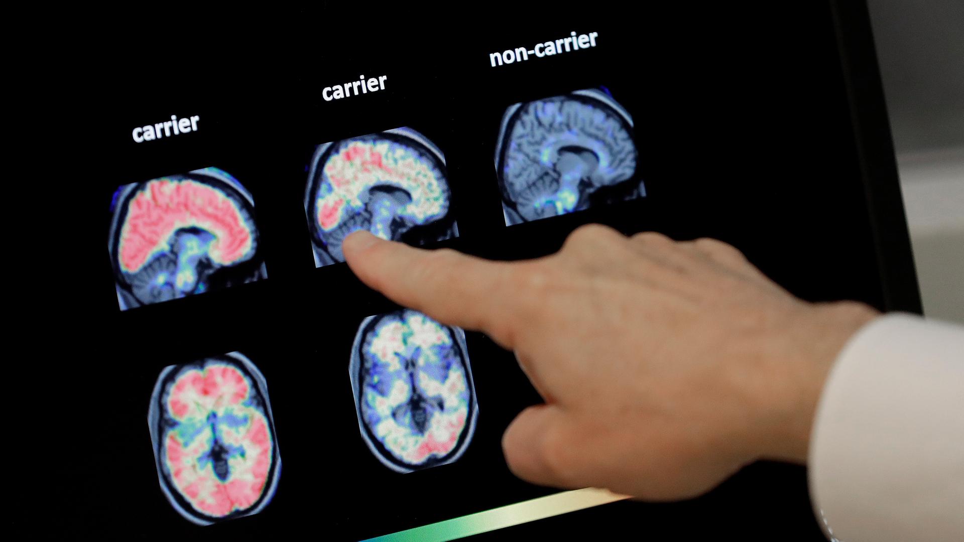 Dr. William Burke begutachtet einen PET-Gehirnscan im Banner Alzheimers Institute in Phoenix. 