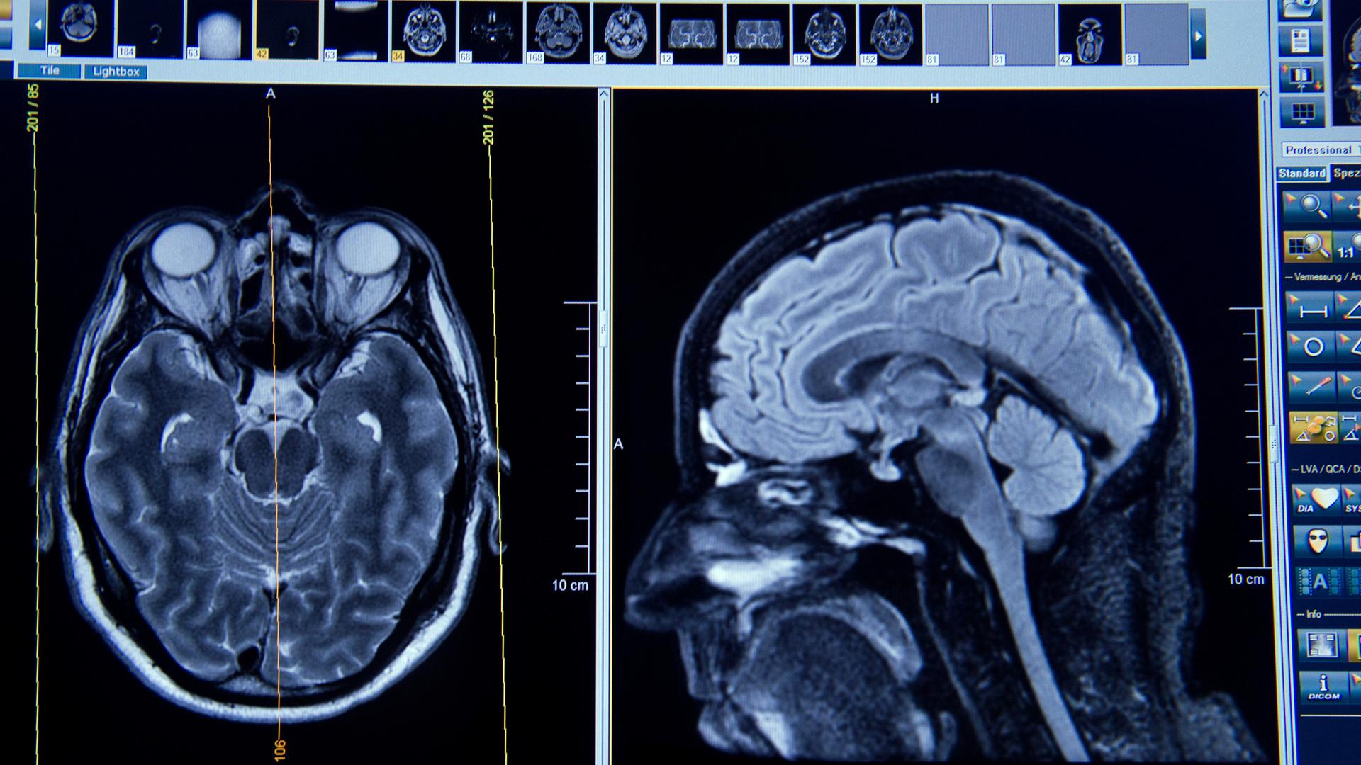 Auf dem Display eines Magnetresonanztomographen sind am 10.07.2015 Schichtaufnahmen eines Gehirns erkennbar Auf dem Display eines Magnetresonanztomographen sind am 10.07.2015 Schichtaufnahmen eines Gehirns erkennbar
