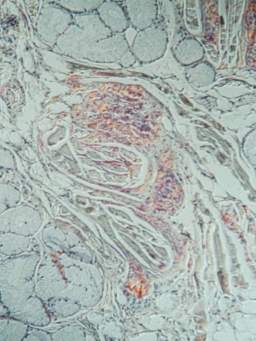 Amyloid-Ablagerungen in krankem Gewebe unter dem Mikroskop.