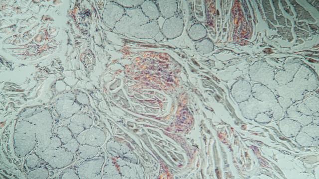 Amyloid-Ablagerungen in krankem Gewebe unter dem Mikroskop.