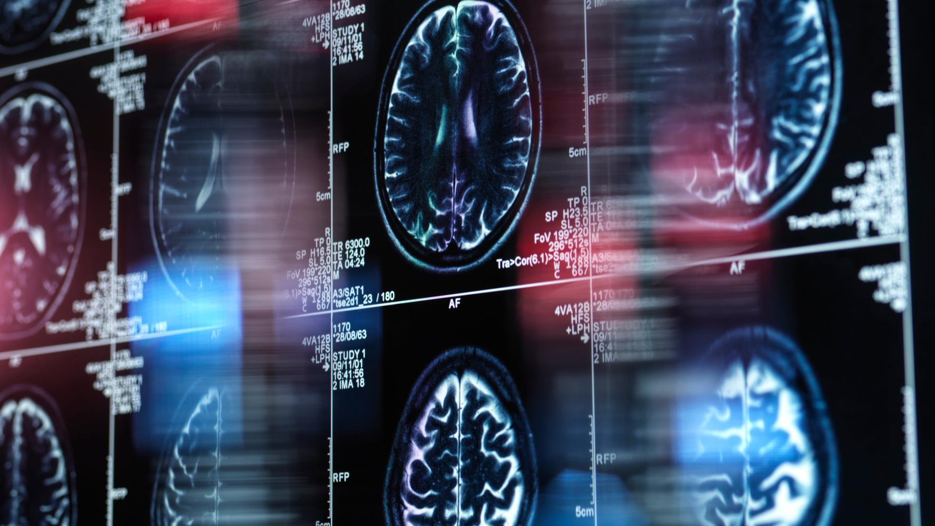 Neurologin Christine von Arnim: Alzheimer den Schrecken nehmen