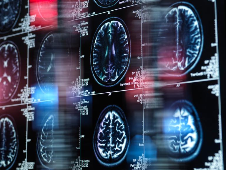 MRT-Scan eines menschlichen Gehirns auf einem Bildschirm.