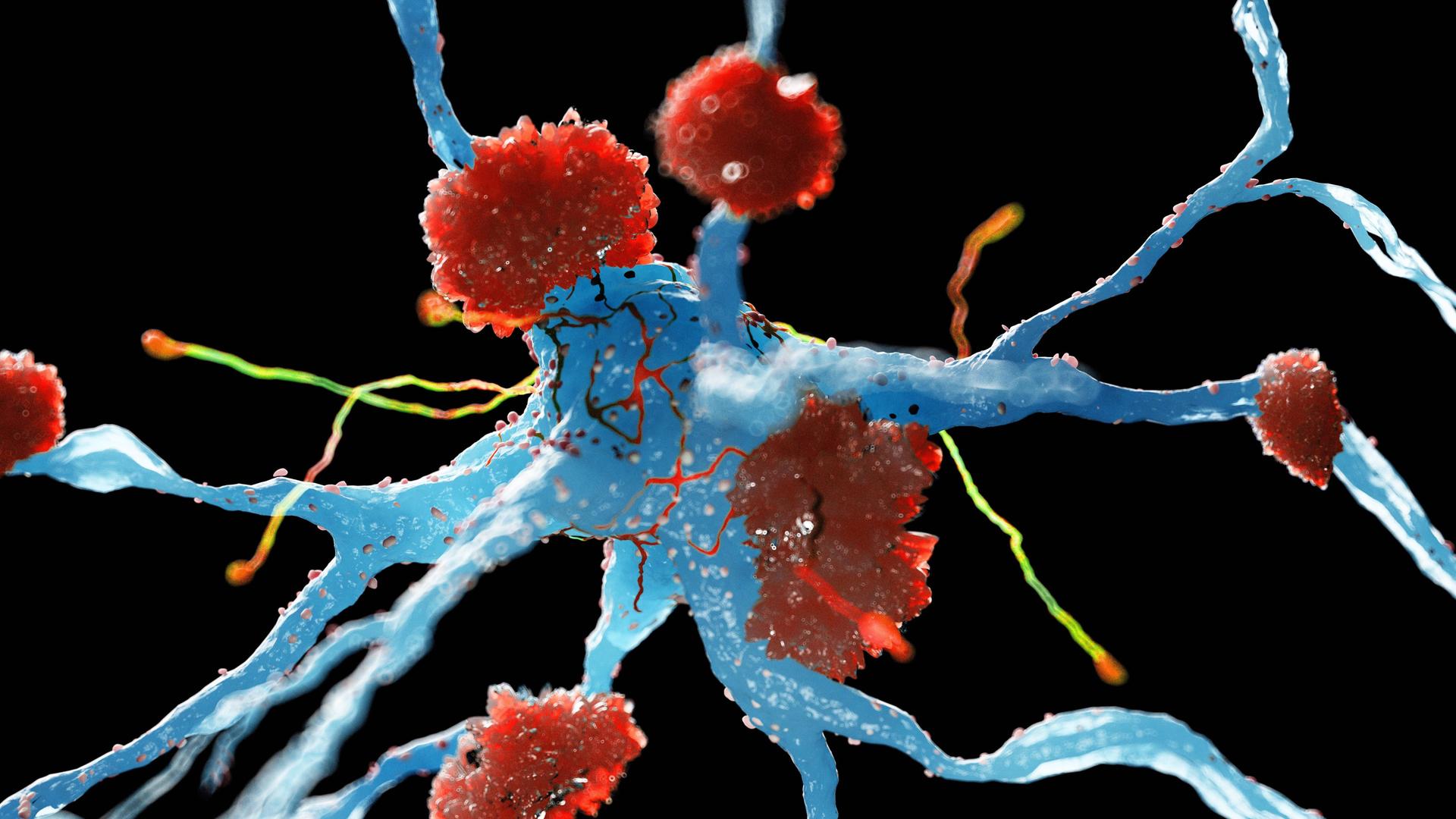 Illustration: Nervenzellen bei Alzheimer mit den Amyloid-Ablagerungen Illustration: Nervenzellen bei Alzheimer mit den Amyloid-Ablagerungen