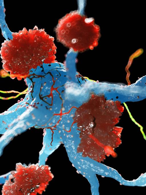 Illustration: Nervenzellen bei Alzheimer mit den Amyloid-Ablagerungen
