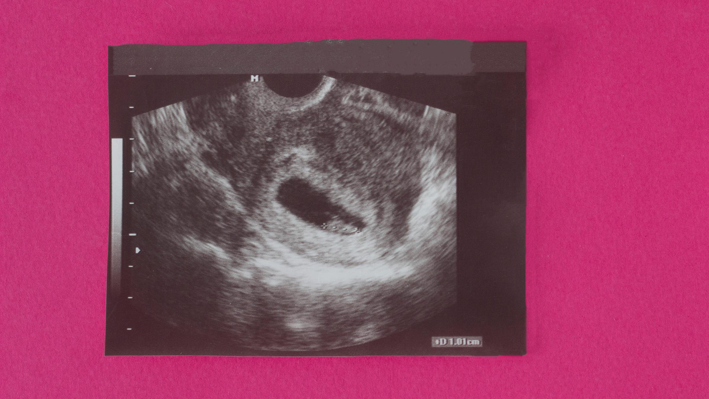 Ein Ultraschallbild ein sehr frühen Schwangerschaft, die Zellen sind 1c...</p>

                        <a href=