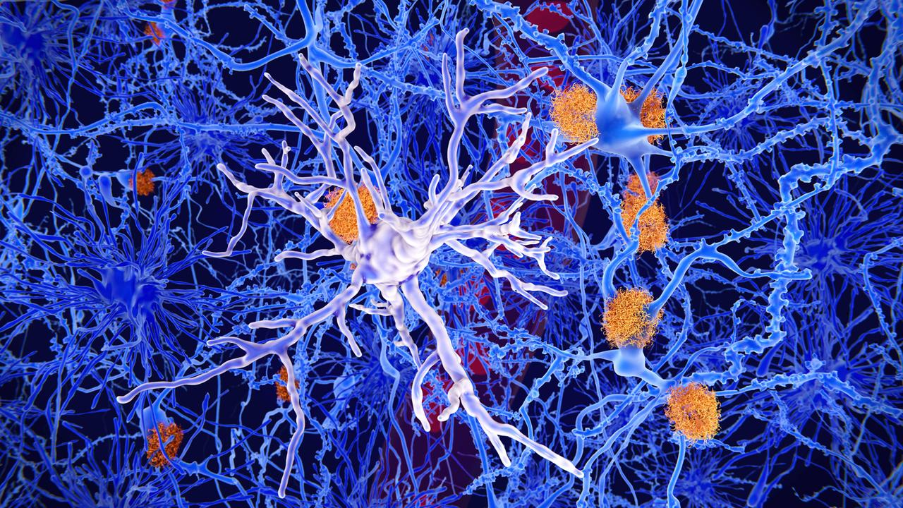 Amyloid-Ablagerungen und eine Mikroglia-Zelle im Gehirn (Illustration)