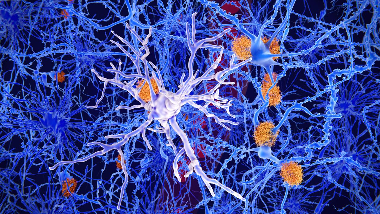 Amyloid-Ablagerungen und eine Mikroglia-Zelle im Gehirn (Illustration) Amyloid-Ablagerungen und eine Mikroglia-Zelle im Gehirn (Illustration)