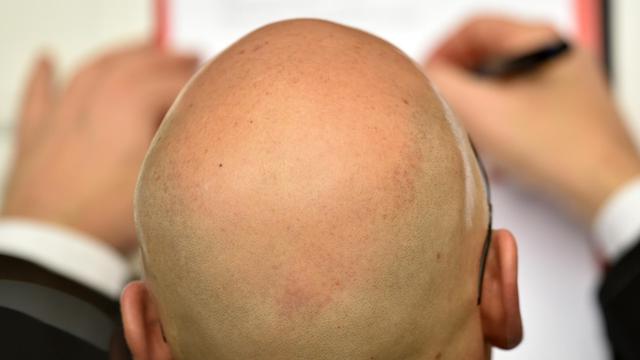 Kleine Männer bekommen eher eine Glatze, wie eine aktuelle Studie belegt.