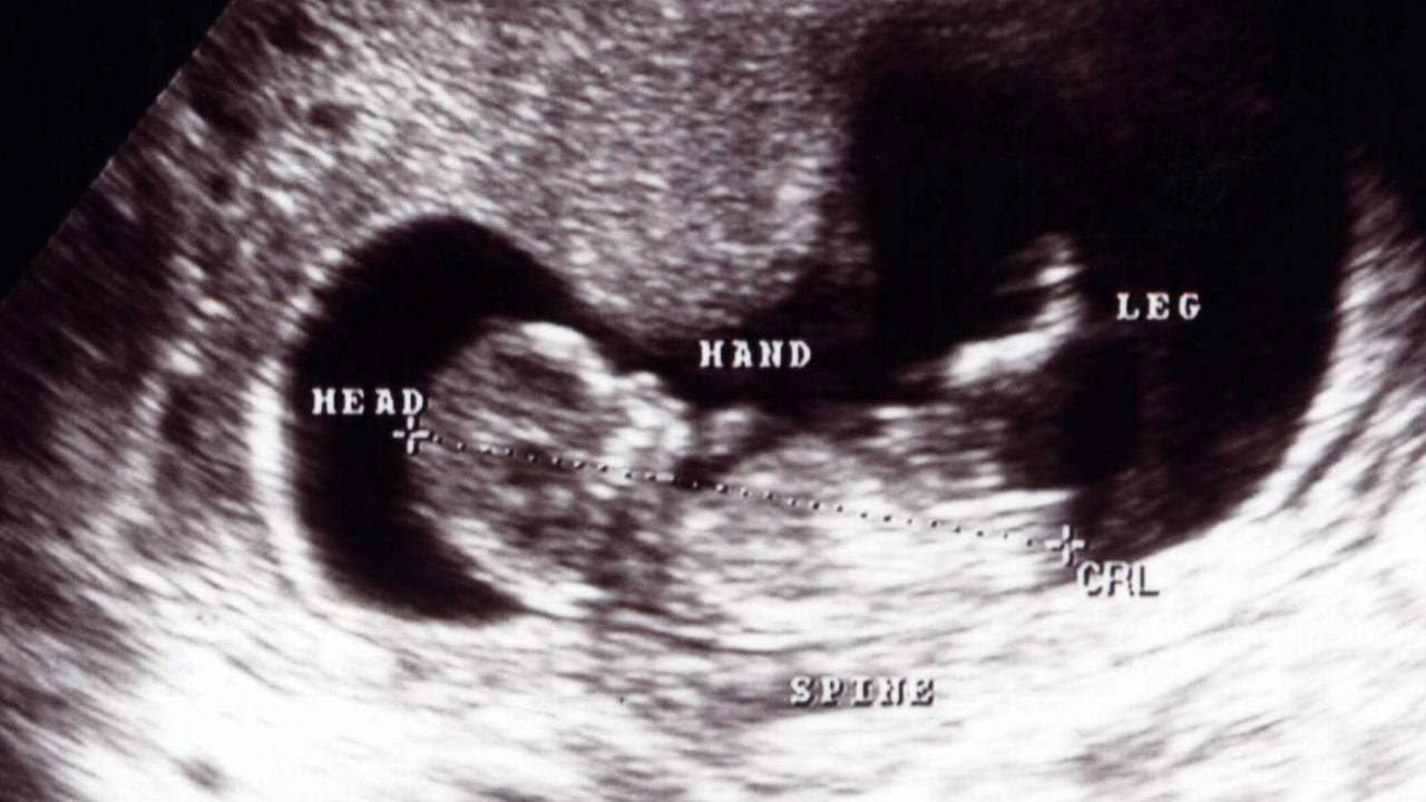 Ultraschallbild eines zwölf Wochen alten Kinds im Mutterleib