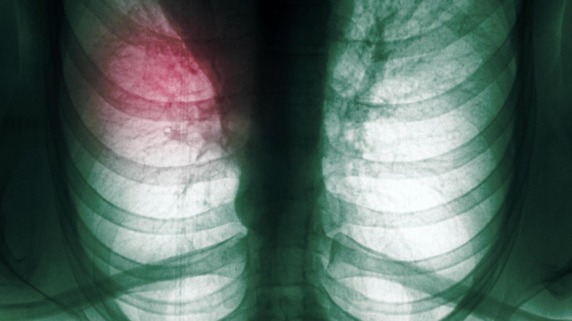 Röntgenaufnahme einer menschlichen Lunge
