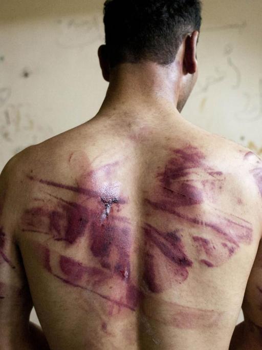 Ein Syrer mit Folterspuren auf dem Rücken.