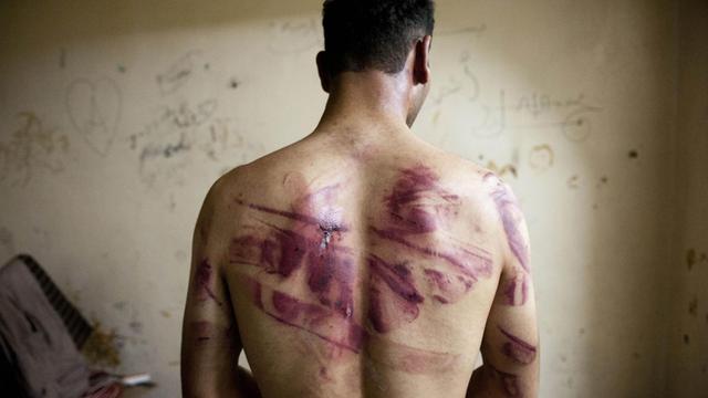 Ein Syrer mit Folterspuren auf dem Rücken.