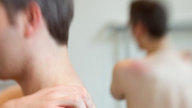 Ein Mann kratzt sich die Haut am Rücken am Freitag (17.09.2010) in der Poliklinik für Hautkrankheiten am Universitätsklinikum Münster (UKM)
