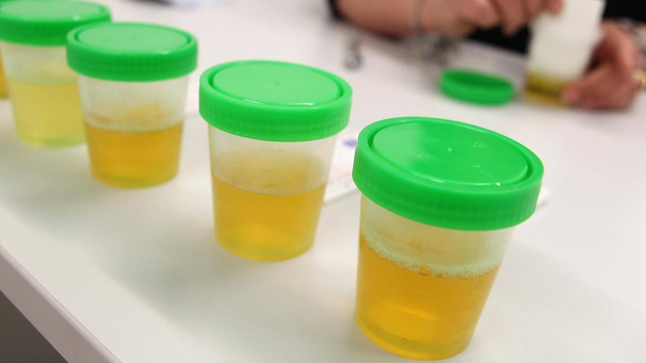 Mehrere Urin-Proben stehen in Plastik-Bechern auf einem Tisch 