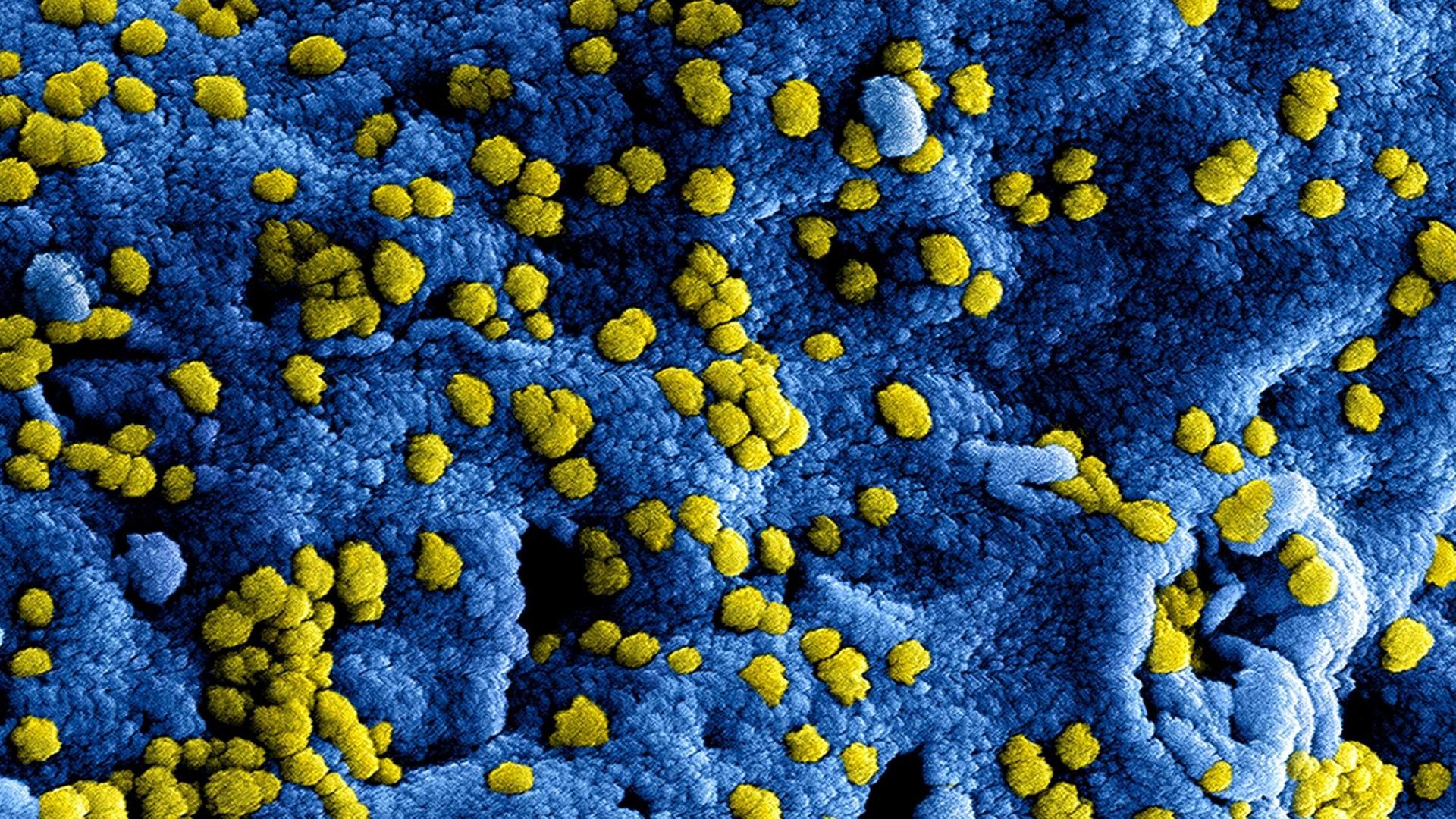 HANDOUT - Produced by the National Institute of Allergy and Infectious Diseases (NIAID), this highly-magnified, digitally-colorized scanning electron micrograph (SEM) reveals ultrastructural details at the site of interaction of numerous yellow-colored Middle East respiratory syndrome Coronavirus (MERS-CoV) viral particles that were on the surface of a Vero E6 cell, which had been colorized blue. MERS-CoV was identified in 2012 as the cause of respiratory illness in people. Investigations are being done to figure out the source of MERS-CoV and how it spreads. So far, there are no reports of anyone in the U.S. getting infected with MERS-CoV. Most people who got infected with MERS-CoV developed severe acute respiratory illness with symptoms of fever, cough, and shortness of breath. About half of them died. Some people were reported as having a mild respiratory illness. MERS-CoV has been shown to spread between people who are in close contact. Transmission from infected patients to healthcare personnel has also been observed. Clusters of cases in Saudi Arabia, Jordan, the UK, France, Tunisia, and Italy are being investigated. Photo: National Institute of Allergy and Infectious Diseases (NIAID) 2014/dpa (ACHTUNG: Nur zur redaktionellen Verwendung im Zusammenhang mit der aktuellen Berichterstattung und nur bei Nennung: "Foto: National Institute of Allergy and Infectious Diseases (NIAID) 2014/dpa"; zu: "Mann aus Region Osnabrück mit tödlichem Mers-Virus infiziert" vom HANDOUT - Produced by the National Institute of Allergy and Infectious Diseases (NIAID), this highly-magnified, digitally-colorized scanning electron micrograph (SEM) reveals ultrastructural details at the site of interaction of numerous yellow-colored Middle East respiratory syndrome Coronavirus (MERS-CoV) viral particles that were on the surface of a Vero E6 cell, which had been colorized blue. MERS-CoV was identified in 2012 as the cause of respiratory illness in people. Investigations are being done to figure out the source of MERS-CoV and how it spreads. So far, there are no reports of anyone in the U.S. getting infected with MERS-CoV. Most people who got infected with MERS-CoV developed severe acute respiratory illness with symptoms of fever, cough, and shortness of breath. About half of them died. Some people were reported as having a mild respiratory illness. MERS-CoV has been shown to spread between people who are in close contact. Transmission from infected patients to healthcare personnel has also been observed. Clusters of cases in Saudi Arabia, Jordan, the UK, France, Tunisia, and Italy are being investigated. Photo: National Institute of Allergy and Infectious Diseases (NIAID) 2014/dpa (ACHTUNG: Nur zur redaktionellen Verwendung im Zusammenhang mit der aktuellen Berichterstattung und nur bei Nennung: "Foto: National Institute of Allergy and Infectious Diseases (NIAID) 2014/dpa"; zu: "Mann aus Region Osnabrück mit tödlichem Mers-Virus infiziert" vom