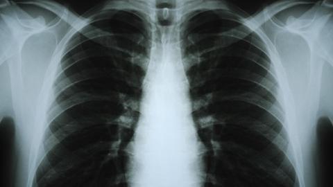 Röntgenbild einer erwachsenen männlichen Brust, digital verändert, um symmetrisch zu sein