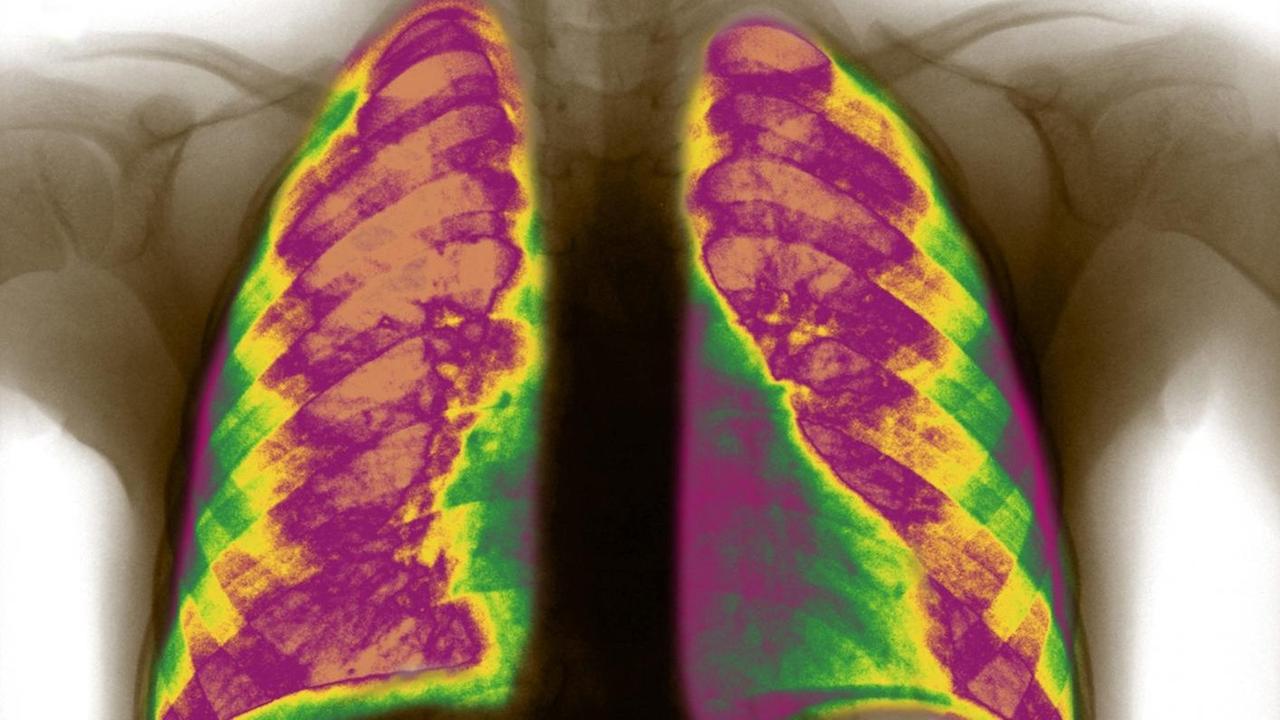 Röntgenbild der Lunge eines Kindes