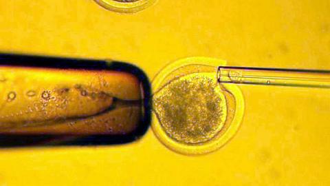 Übertragung der Körperzelle von einer Frau in eine entkernte Eizelle derselben Spenderin