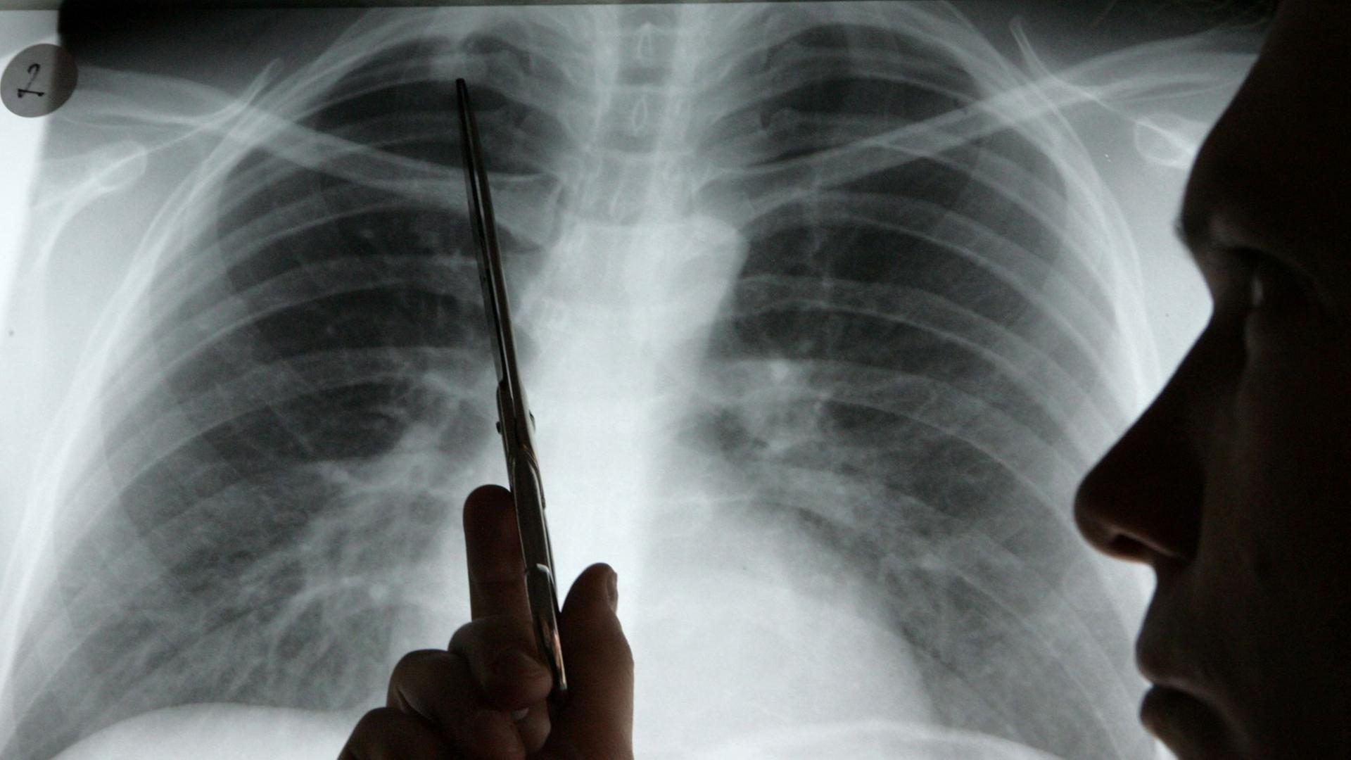 Diagnose Lungenkrebs: Ein Arzt zeigt auf einem Röntgenbild auf einen Tumor. Diagnose Lungenkrebs: Ein Arzt zeigt auf einem Röntgenbild auf einen Tumor.