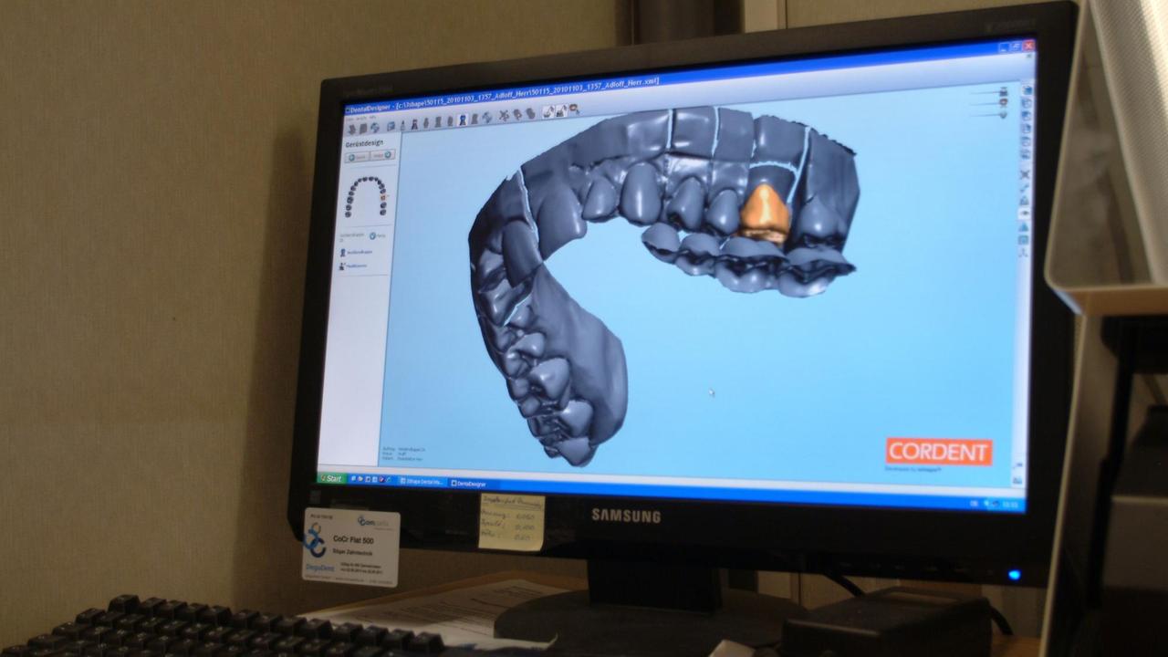 3-D-Bild eines Zahnkiefers zur Herstellung von Zahnersatz.