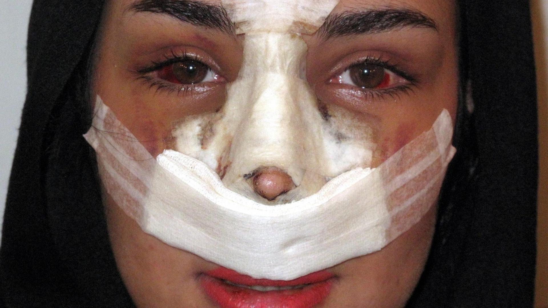 Eine iranische Frau präsentiert sich nach einer Schönheits-Operation im April 2014 in Teheran. Im Gottesstaat Iran müssen Frauen in der Öffentlichkeit Körper und Haare unter Kleidung und Schleier verbergen. Wer glaubt, dass deswegen Schönheits-Operationen keine Rolle spielen, irrt sich. Foto: Panthea Wassegh/dpa