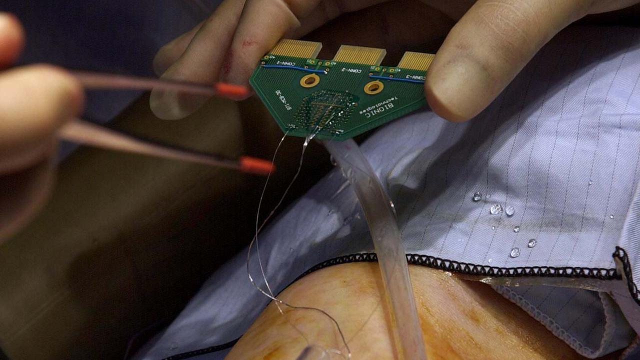 Dem führenden britischen Roboterforscher Professor Kevin Warwick, den britischen Medien auch als "Mr. Cyborg" betiteeln, wird am 14.3.2003 im Radcliffe Infirmary (Krankenhaus) in Oxford ein Chip in den linken Arm implantiert. Durch die Verbindung des Chips mit seinen Nervenfasern können elektronische Signale von Bewegungen und Gefühlen an einen Computer weitergeleitet, gespeichert und an Warwick zurückgeleitet werden. Dem führenden britischen Roboterforscher Professor Kevin Warwick, den britischen Medien auch als "Mr. Cyborg" betiteeln, wird am 14.3.2003 im Radcliffe Infirmary (Krankenhaus) in Oxford ein Chip in den linken Arm implantiert. Durch die Verbindung des Chips mit seinen Nervenfasern können elektronische Signale von Bewegungen und Gefühlen an einen Computer weitergeleitet, gespeichert und an Warwick zurückgeleitet werden.