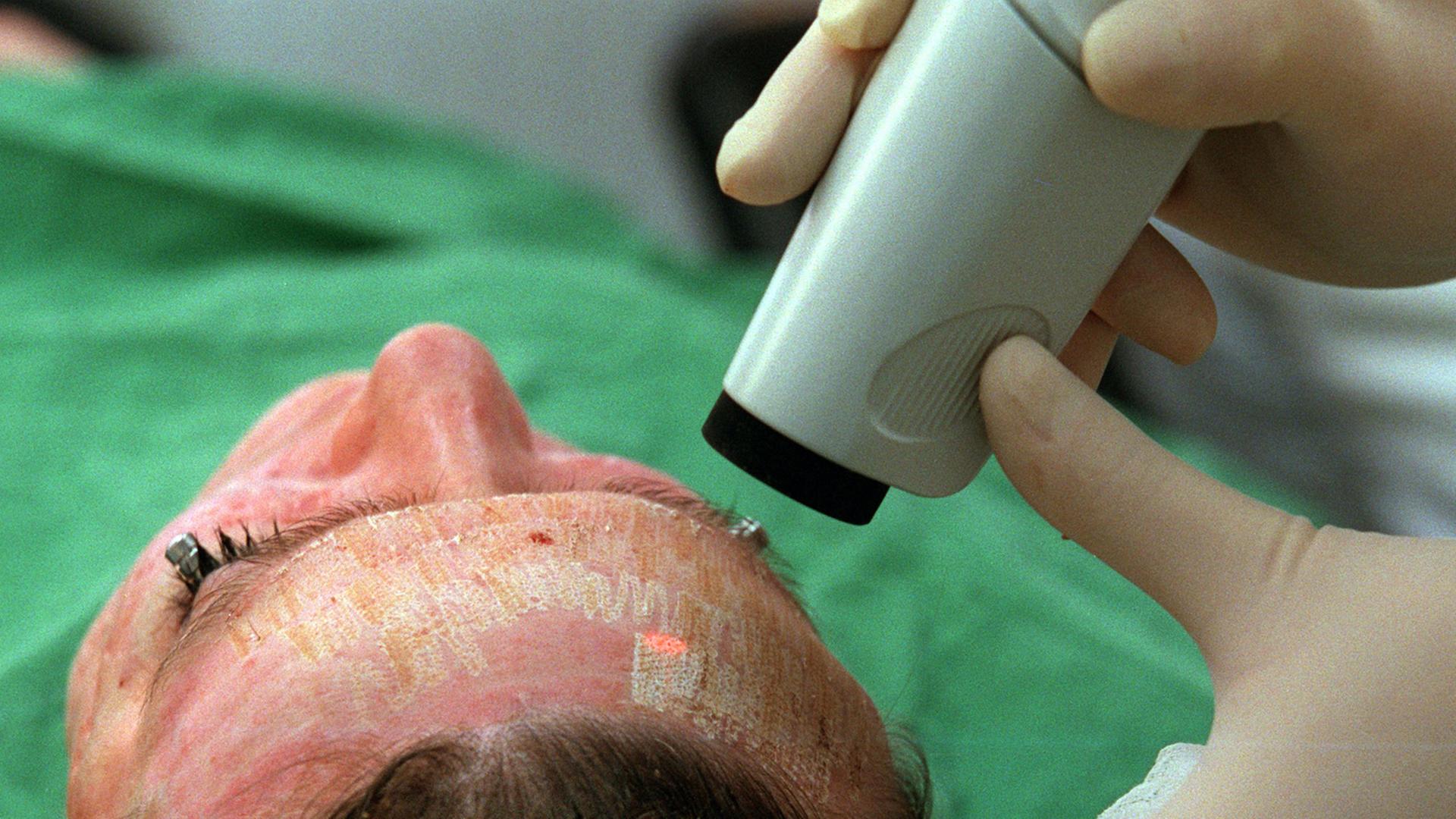 Ein Arzt entfernt Aknenarben auf dem Gesicht einer jungen Frau mit einem Laser.