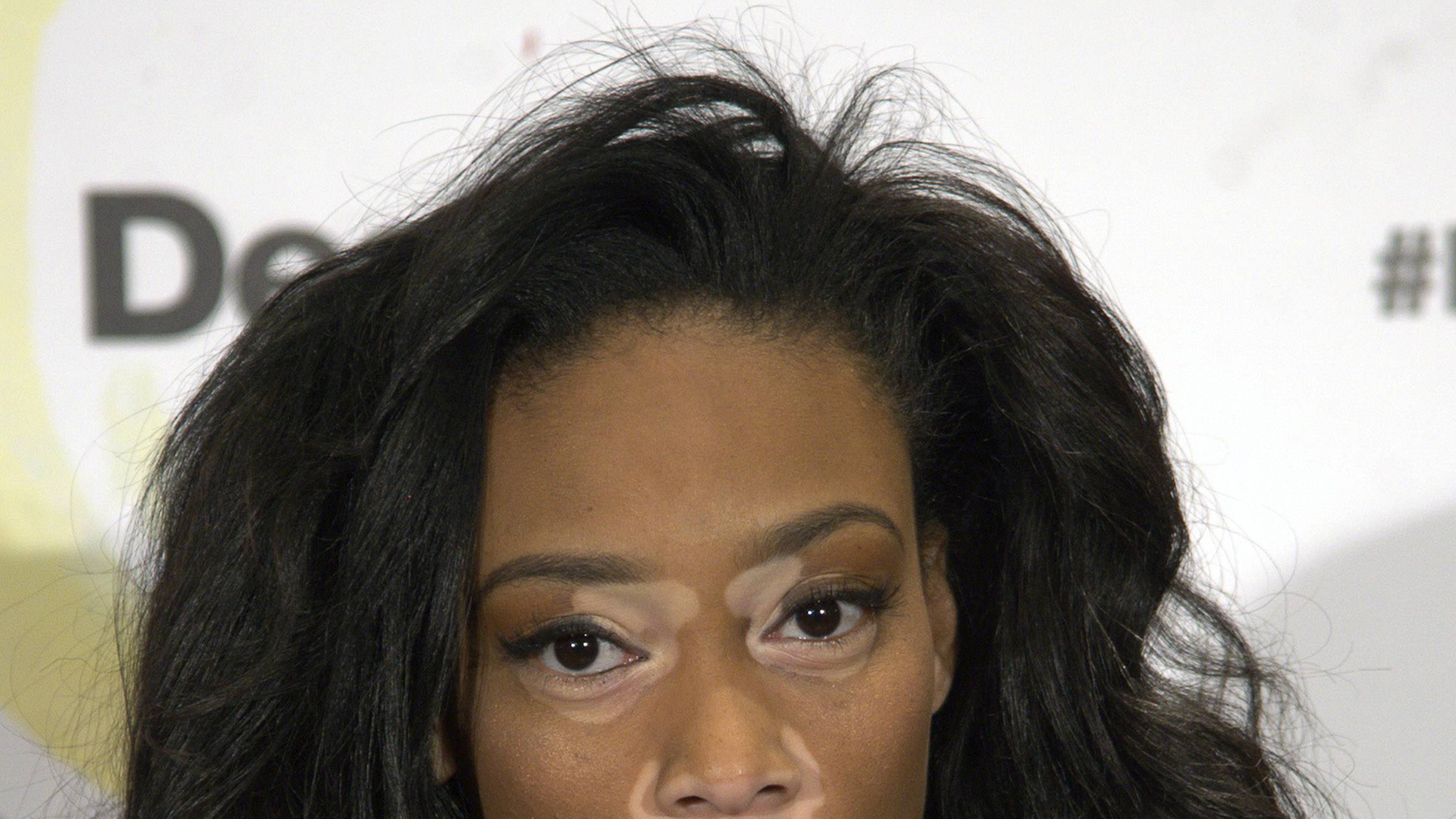 Modell Chantelle Brown-Young hat die Hautkrankheit Vitiligo