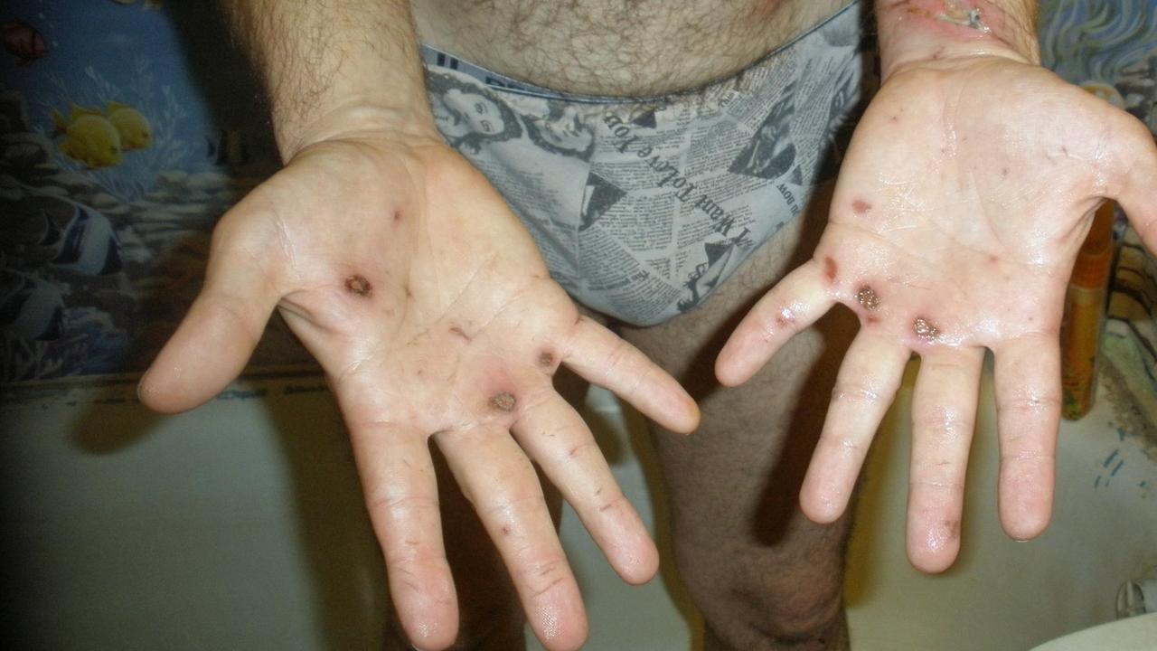 Ein ukrainisches Folteropfer zeigt die Wunden an seinen Händen. Ein ukrainisches Folteropfer zeigt die Wunden an seinen Händen.
