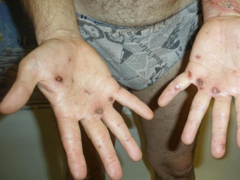 Ein ukrainisches Folteropfer zeigt die Wunden an seinen Händen.