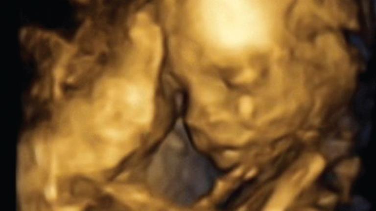 3D-Bild des Fötus auf einer Ultraschallaufnahme in der 18. Schwangerschaftswoche 3D-Bild des Fötus auf einer Ultraschallaufnahme in der 18. Schwangerschaftswoche