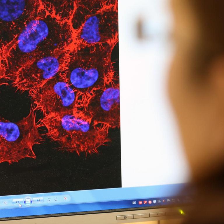 Im Labor des Instituts für Experimentelle Gentherapie und Tumorforschung (IEGT) der Universitätsmedizin Rostock (Mecklenburg-Vorpommern) schaut eine Doktorandin am 22.10.2013 auf ein Monitorbild von Melanom-Zellen (schwarzer Hautkrebs). 