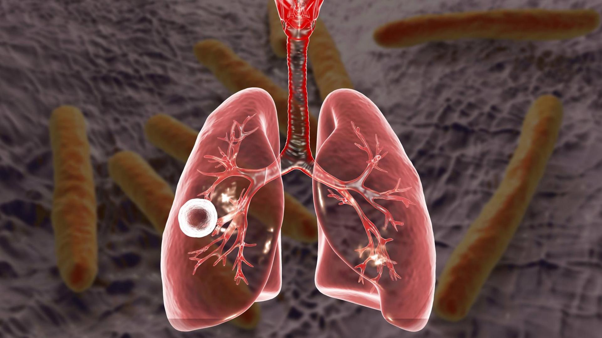 Eine Computerillustration zeigt den Tuberkulose-Erreger und das davon betroffene Lungengewebe. Eine Computerillustration zeigt den Tuberkulose-Erreger und das davon betroffene Lungengewebe.