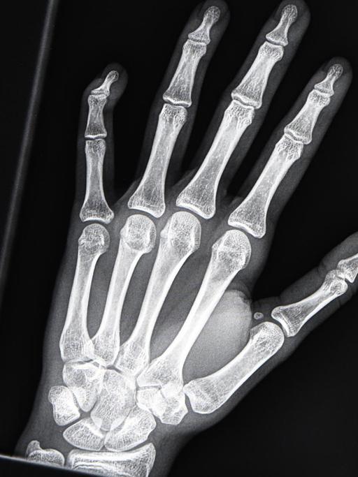 Ein Röntgenbild auf einem Bildschirm zeigt die linke Hand eines jungen Menschen im Alter zwischen 16 und 19 Jahren