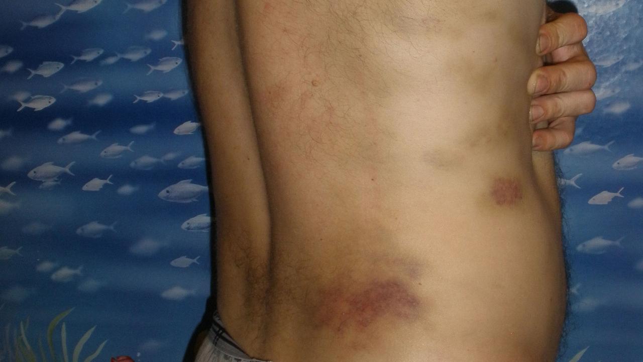 Ein Opfer von Folter zeigt die Spuren der Misshandlungen. Ein Opfer von Folter zeigt die Spuren der Misshandlungen.