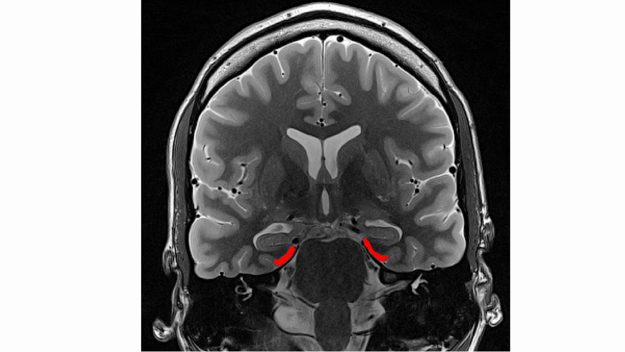 Magnetresonanztomografie-Bild eines menschlichen Hirns, der entorhinale Kortex ist rot markiert; Illustration zur Publikation in "Current Biology" 