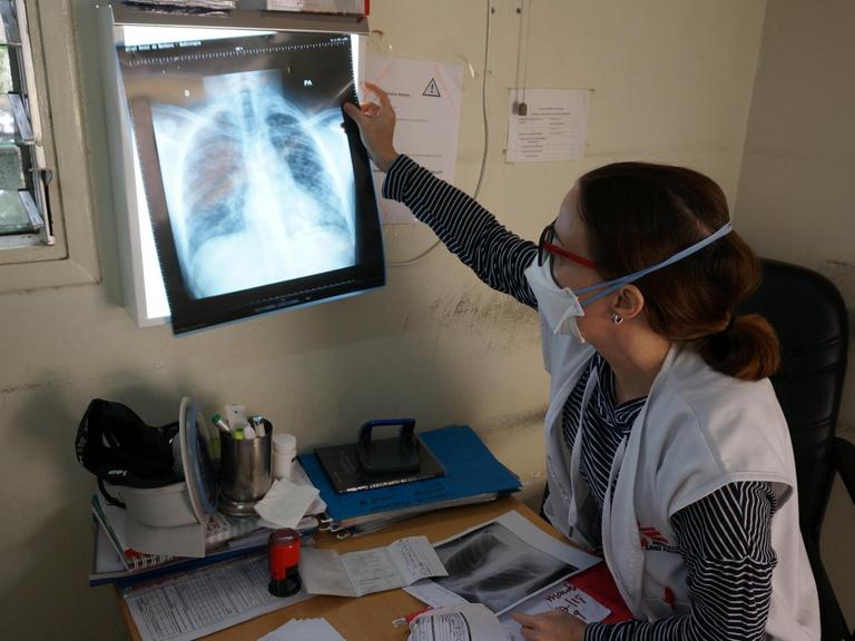 Die Internistin Miriam Arago Galindo vom Tuberkulose-Projekt von "Ärzte ohne Grenzen" in Mozambik analysiert eine Röntgenaufnahme vom Brustkorb eines Patienten.