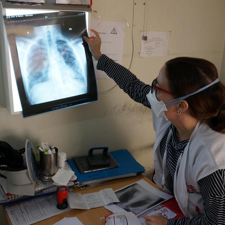 Die Internistin Miriam Arago Galindo vom  Tuberkulose-Projekt von "Ärzte ohne Grenzen" in Mozambik analysiert eine Röntgenaufnahme vom Brustkorb eines Patienten.