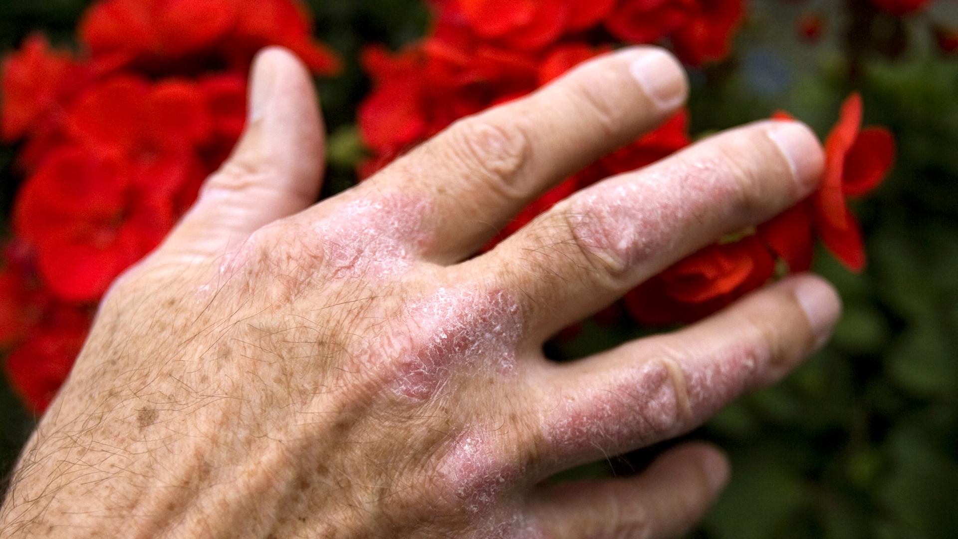 Eine Hand mit mit Schuppenflechte oder Psoriasis