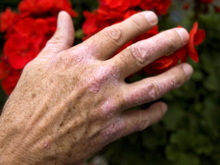 Eine Hand mit mit Schuppenflechte oder Psoriasis