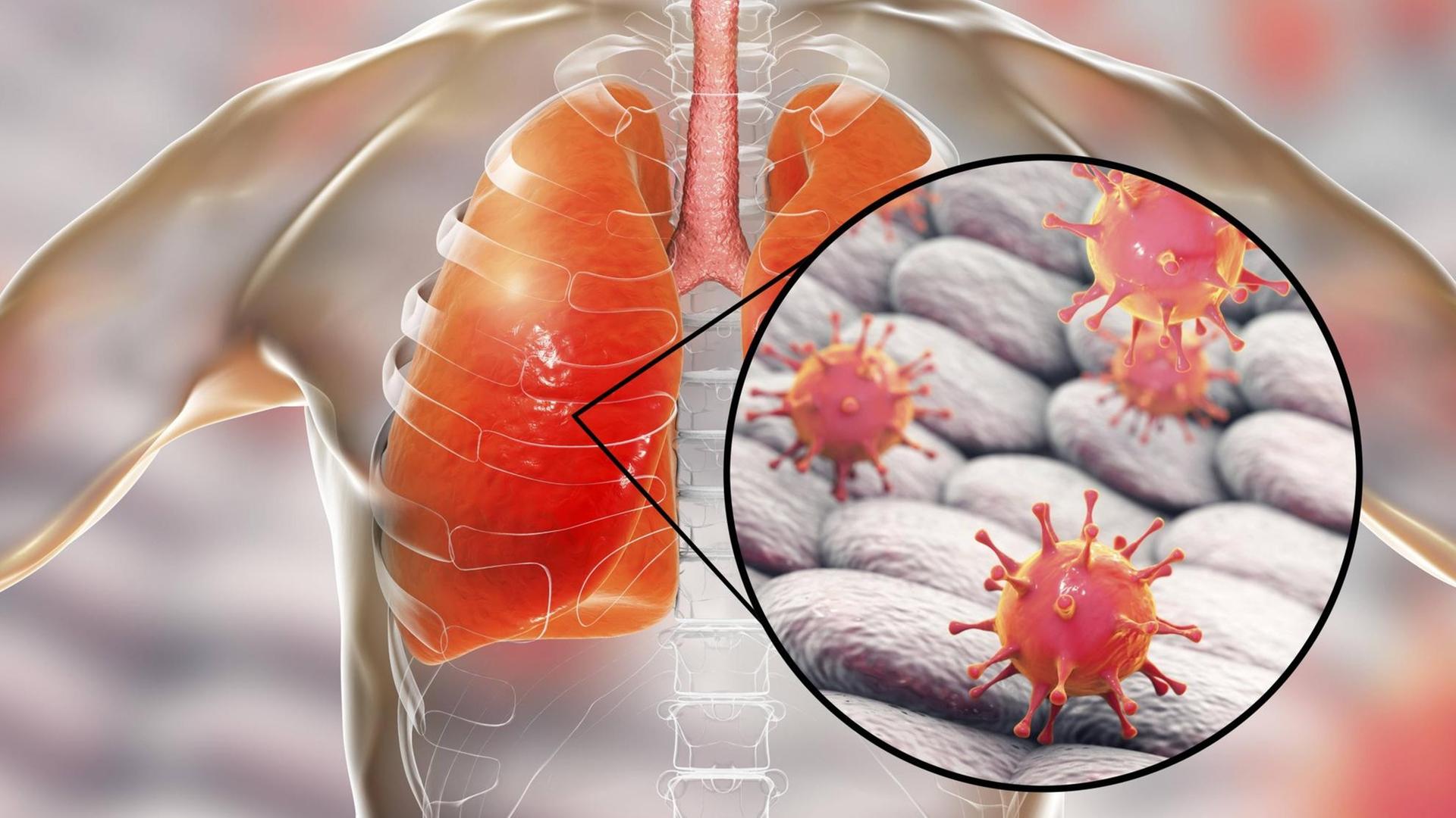 Illustrative Darstellung einer viralen Lungentzündung mit Blick in das innere eines Menschen, die von Coronaviren verursacht werden kann.