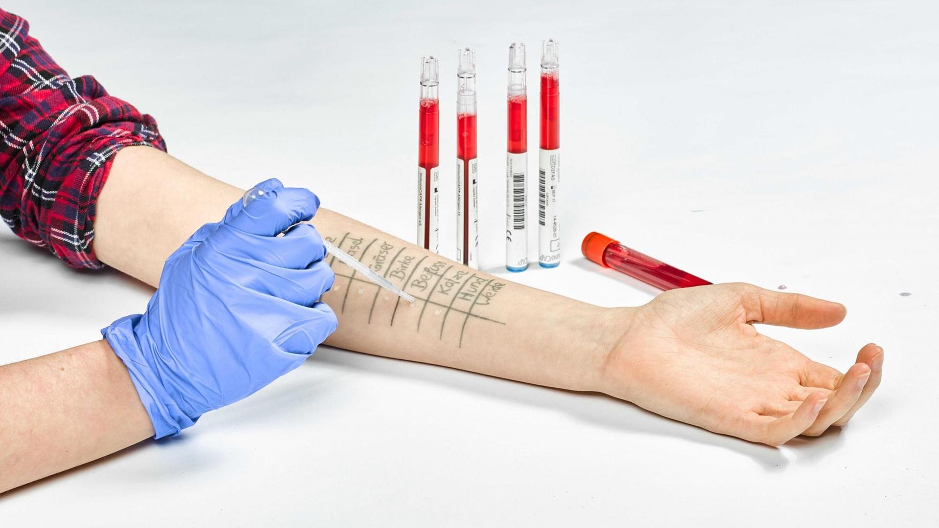 Der Pricktest dient zum Nachweis einer sogenannten Typ I Allergie, wie zum Beispiel einer Sensibilisierung gegenüber Pollen oder Tierhaaren. Der Pricktest dient zum Nachweis einer sogenannten Typ I Allergie, wie zum Beispiel einer Sensibilisierung gegenüber Pollen oder Tierhaaren.