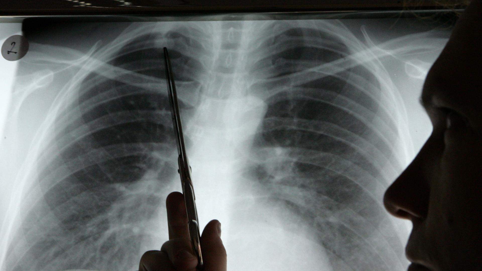 Ein Arzt zeigt auf das Röntgenbild einer Lunge. 