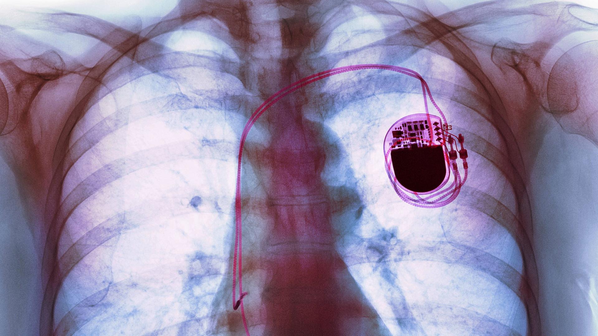 Röntgenaufnahme eines Patienten mit einem Herzschrittmacher Röntgenaufnahme eines Patienten mit einem Herzschrittmacher