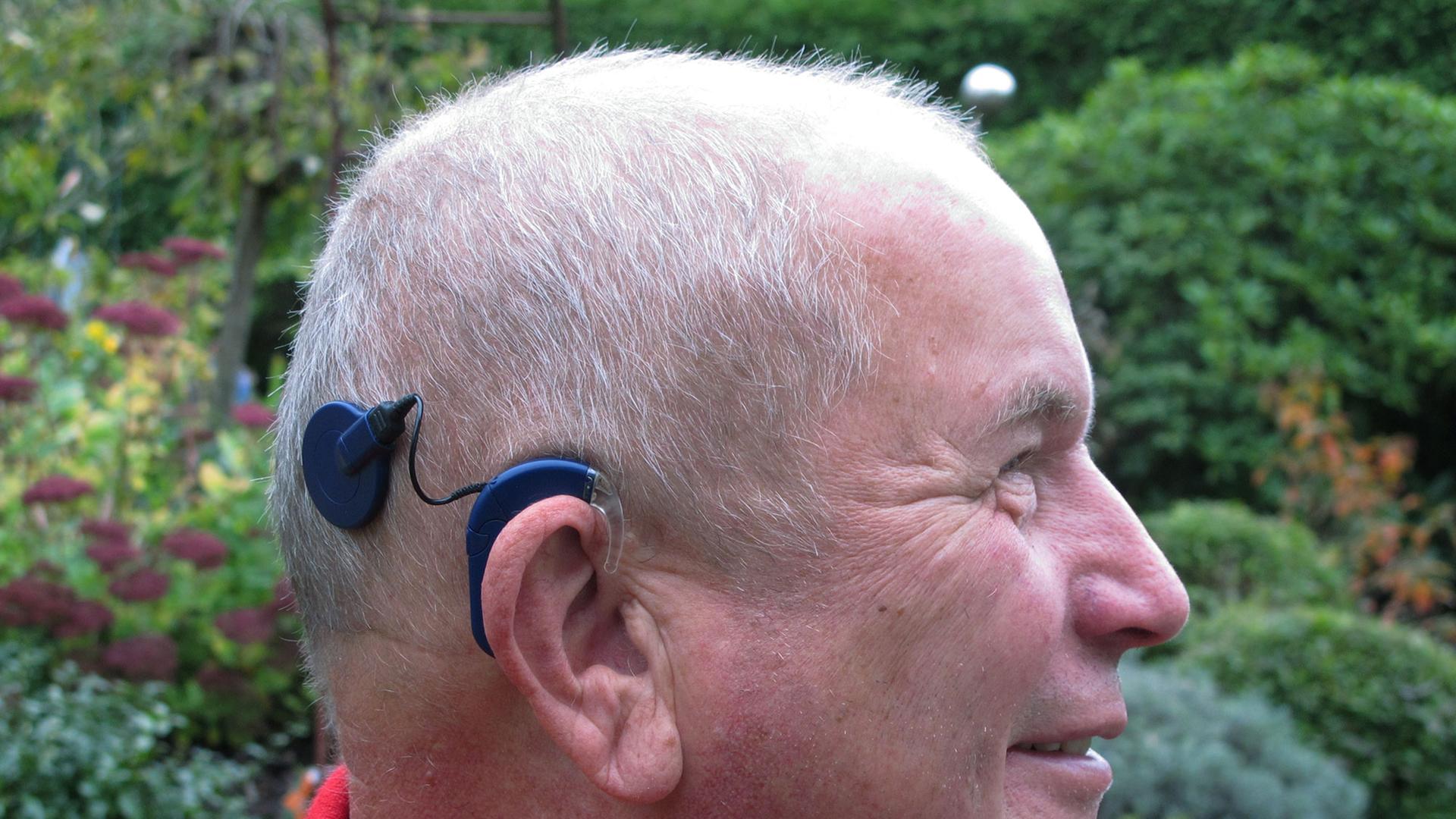 Patient mit Hörimplantat: Der Mann hat sich ein sogenanntes Cochlea-Implantat einsetzen lassen. Dabei wird hinter der Ohrmuschel ein Elektrodenträger in das Innenohr eingesetzt. Über ein kleines Mikrofon am Ohr werden die Töne und Laute über ein Kabel von außen zum Elektrodenträger geleitet - und der Hörnerv elektrisch stimuliert. Das Gehirn erkennt dann den Schall. Patient mit Hörimplantat: Der Mann hat sich ein sogenanntes Cochlea-Implantat einsetzen lassen. Dabei wird hinter der Ohrmuschel ein Elektrodenträger in das Innenohr eingesetzt. Über ein kleines Mikrofon am Ohr werden die Töne und Laute über ein Kabel von außen zum Elektrodenträger geleitet - und der Hörnerv elektrisch stimuliert. Das Gehirn erkennt dann den Schall.