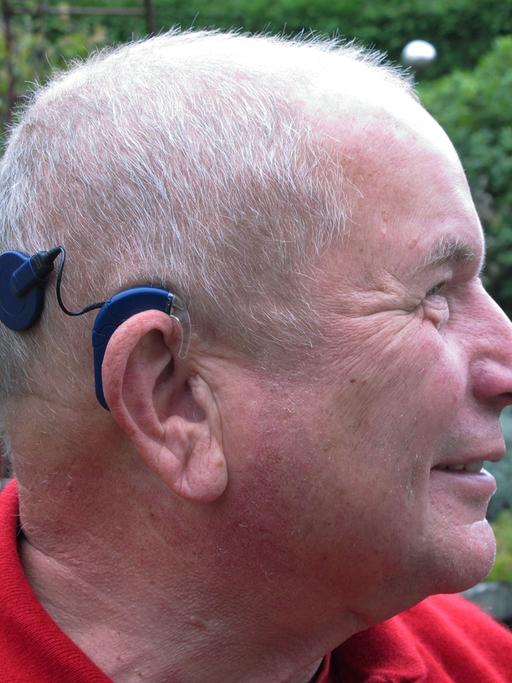 Patient mit Hörimplantat: Der Mann hat sich ein sogenanntes Cochlea-Implantat einsetzen lassen. Dabei wird hinter der Ohrmuschel ein Elektrodenträger in das Innenohr eingesetzt. Über ein kleines Mikrofon am Ohr werden die Töne und Laute über ein Kabel von außen zum Elektrodenträger geleitet - und der Hörnerv elektrisch stimuliert. Das Gehirn erkennt dann den Schall.