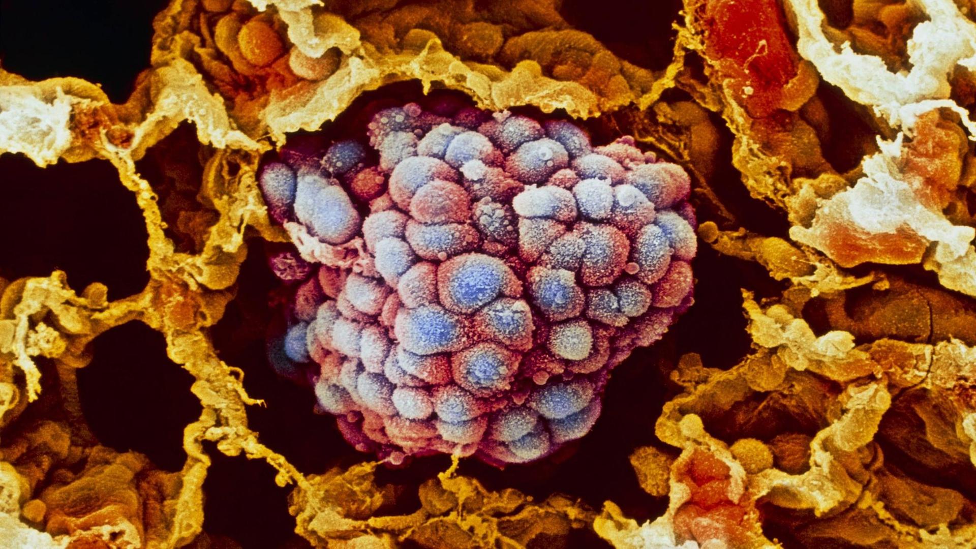 Kolorierte Aufnahme eines Lungen-Tumors unter dem Rasterelektronenmikroskop Kolorierte Aufnahme eines Lungen-Tumors unter dem Rasterelektronenmikroskop