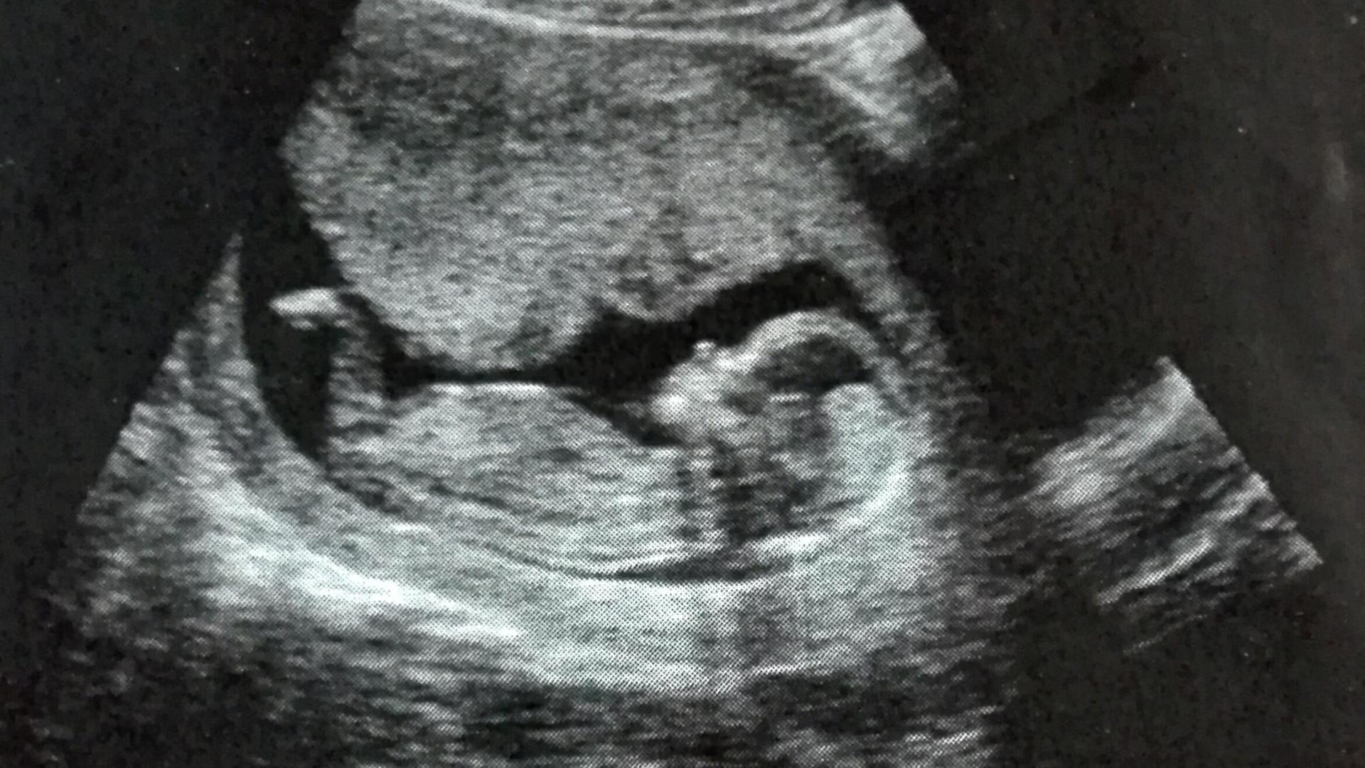 Ein Ultraschallbild. Zu sehen ist das Baby im Mutterleib. Ein Ultraschallbild. Zu sehen ist das Baby im Mutterleib.
