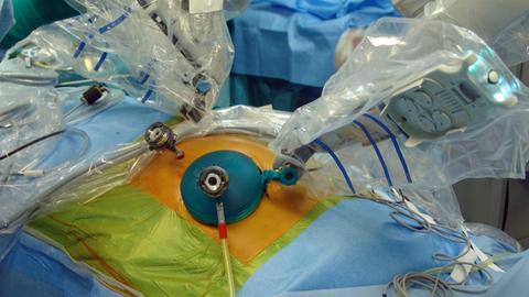 Roboterarme über dem Patienten bei einer Bauchspeicheldrüsen-OP mit dem "Da Vinci"-Roboter